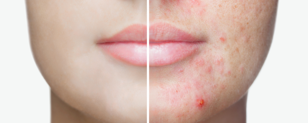 Kaj so akne in kako jih zdravimo?