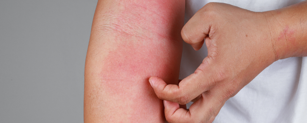 Atopijski dermatitis