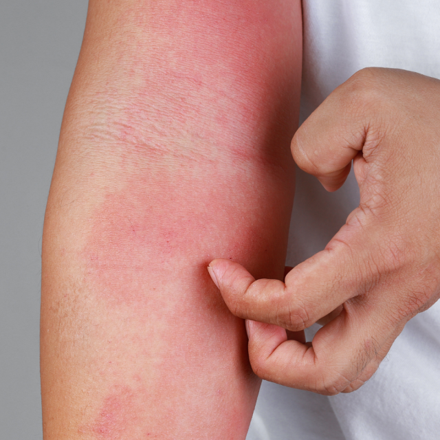 Atopijski dermatitis