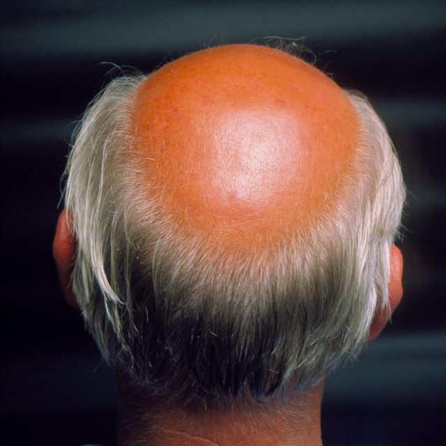 Izpadanje las (alopecija)