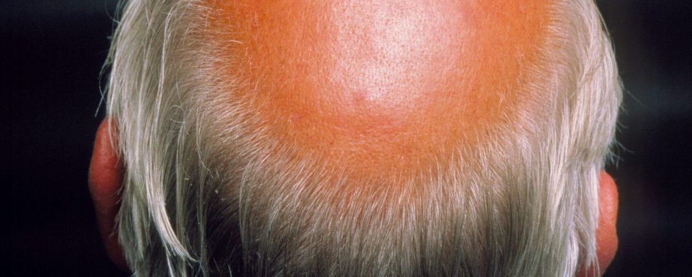 Izpadanje las (alopecija)